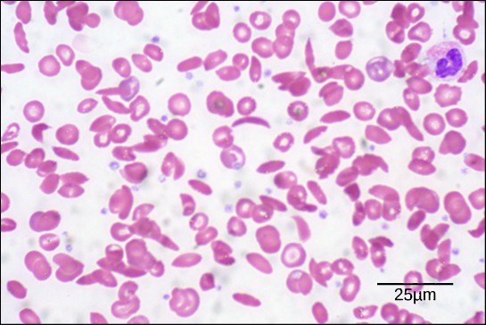In this blood smear, visualized at 535x magnification using bright field microscopy, sickle cells are crescent shaped, while normal cells are disc-shaped. (credit: modification of work by Ed Uthman; scale-bar data from Matt Russell)